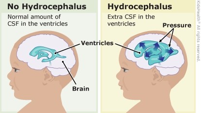 Hydrocephalus - Causes, Types, Symptoms and Treatments