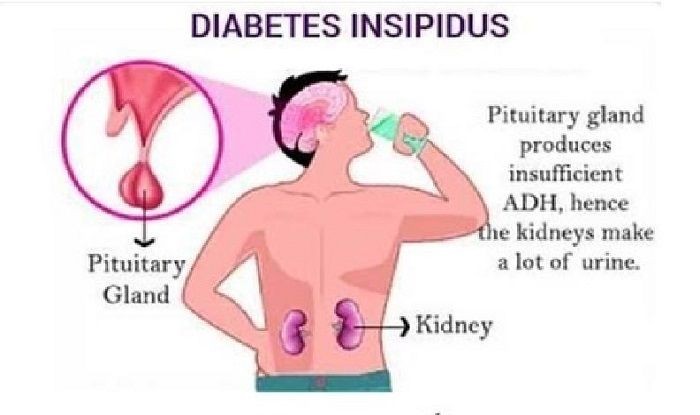 Diabetes insipidus - Symptome,, , Vorbeugung und Behandlung