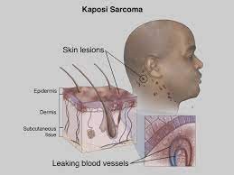 Kaposi-Sarkom – Ursache, Diagnose und Behandlung