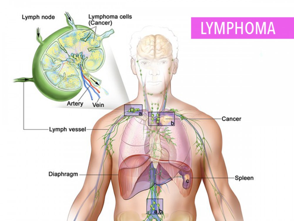 سرطان الغدد الليمفاوية - الأعراض والأسباب والعلاج
