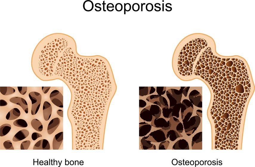 Osteoporose - Symptome und Behandlungen