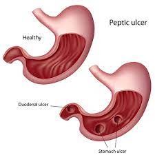 Peptic Ulcer Disease - Causes and Treatment